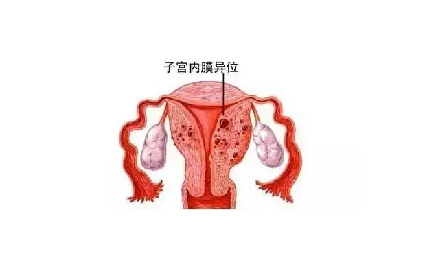 试管婴儿之子宫腺肌病合并不孕的助孕方案