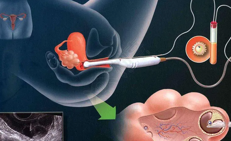取卵后，生殖医生一般会在什么时候进行胚胎移植?