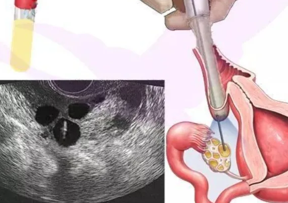 试管需要多次取卵攒胚胎对女性身体伤害大吗?