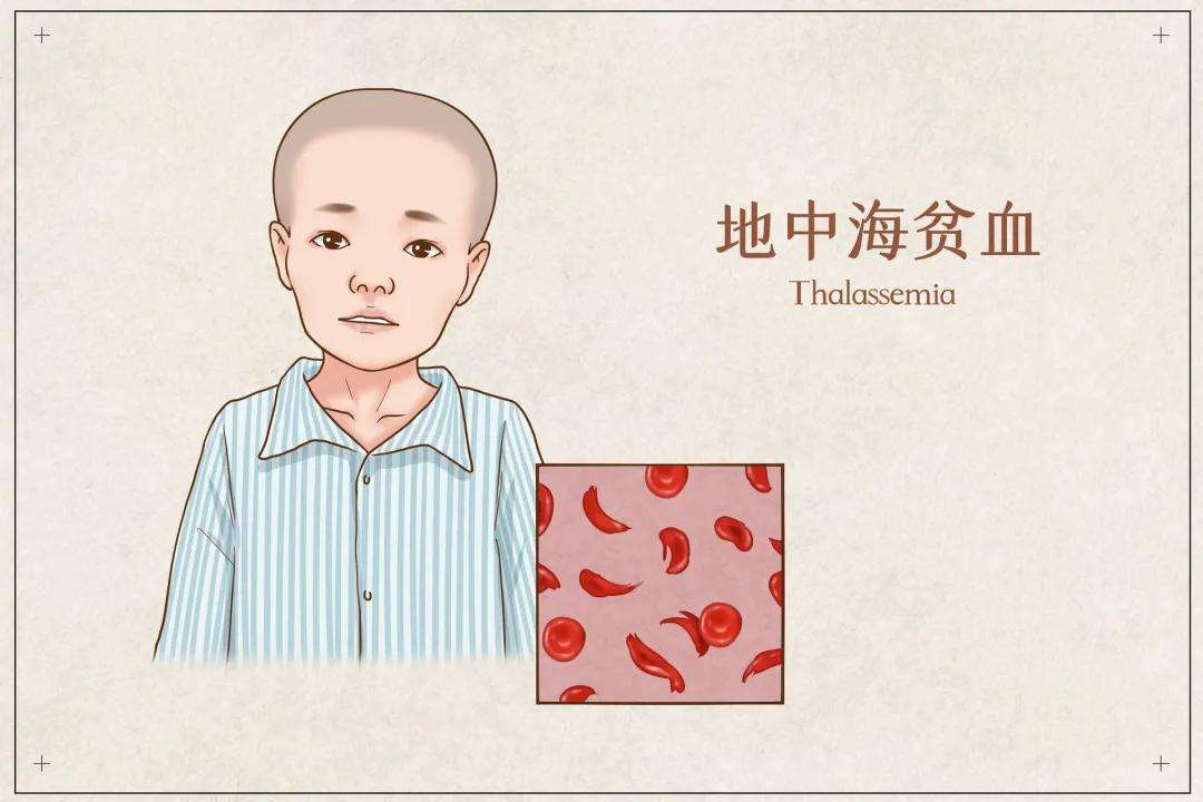地贫必须做第三代试管