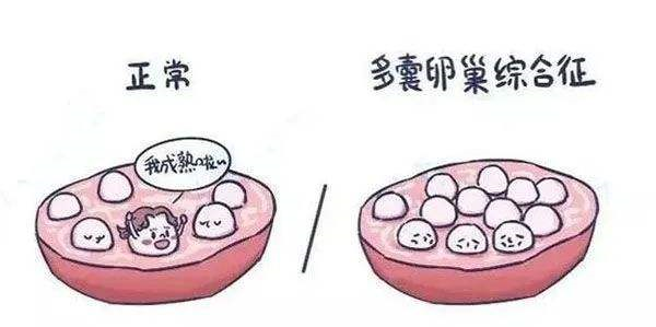 多囊卵巢试管婴儿成功率大吗
