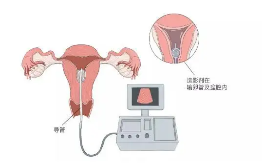 输卵管造影检查完多久能要孩子